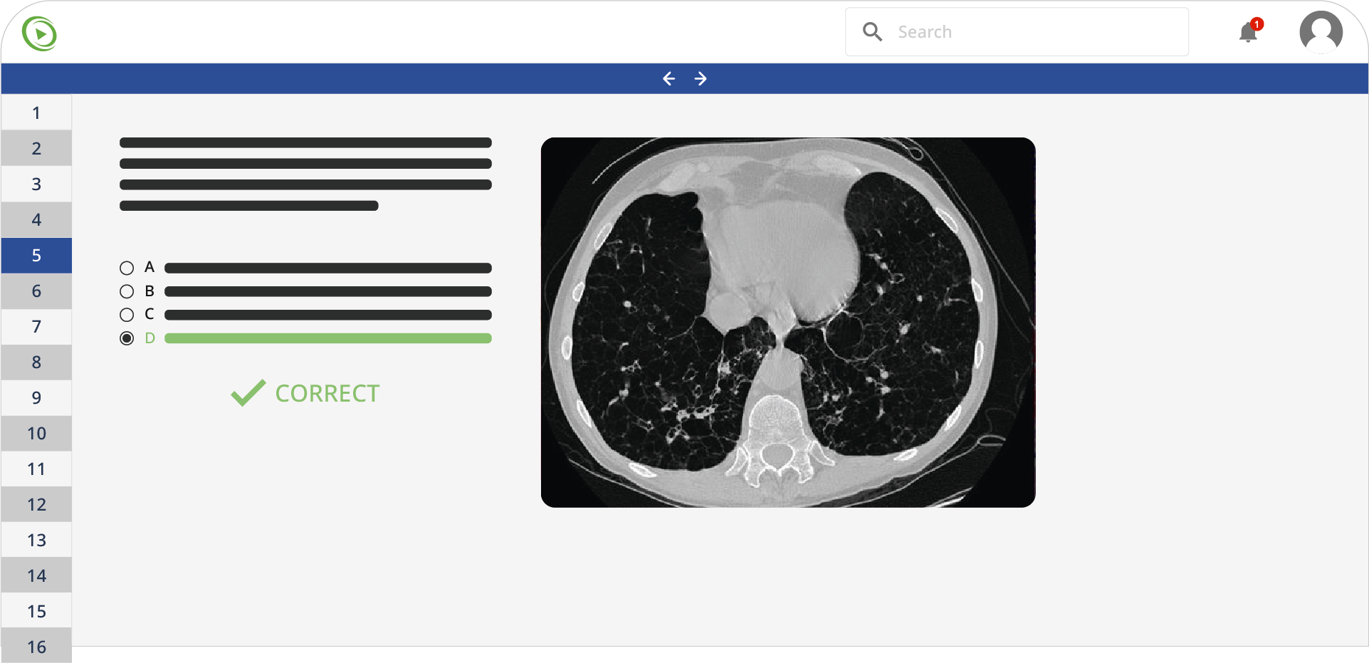 Ct scan of lungs with a selected multiple-choice medical question.